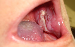 cáncer oral